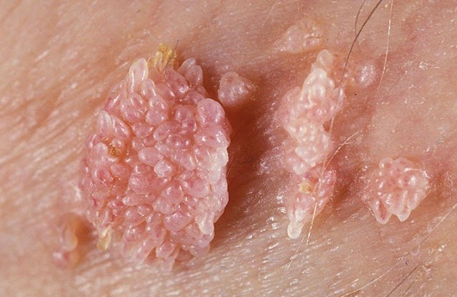Manage about anal genetal warts Question Certainly. about anal genetal warts conversations!